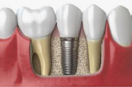 Dental Implant