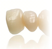 Emax dental veneers