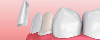 Porcelain Veneers
