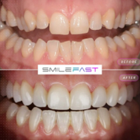 Smile Fast