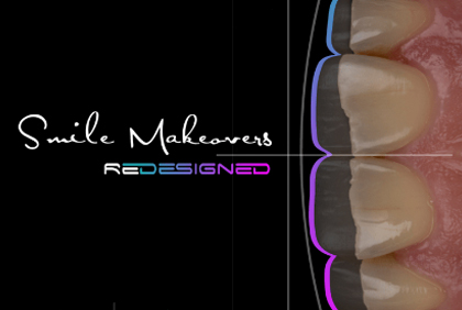 Smile Makeover